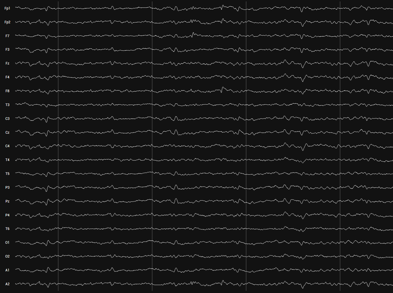 Tracé EEG brut enregistré sur 21 canaux lors d’une mesure de repos les yeux ouverts
